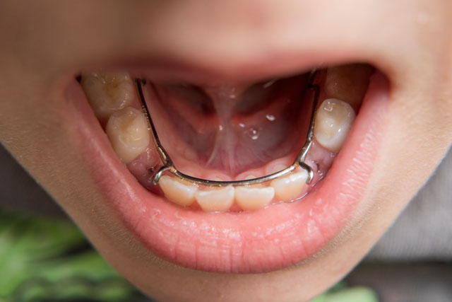 young boy showing off his lingual side dental space maintainer